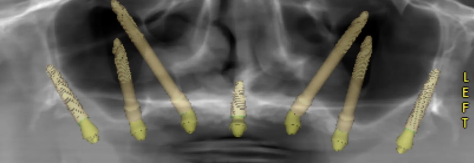 Planejamento digital de implantes a partir de dados de tomografia